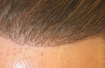  artificial hair implant - Exoderm Medical Centers