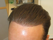 Hair implant Exoderm