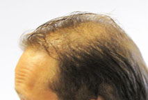  Artificial hair implant - Exoderm