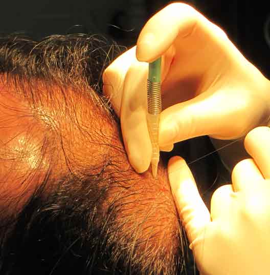 Hair Transplantat FUE Biofibre Nido synthetic Hair implant