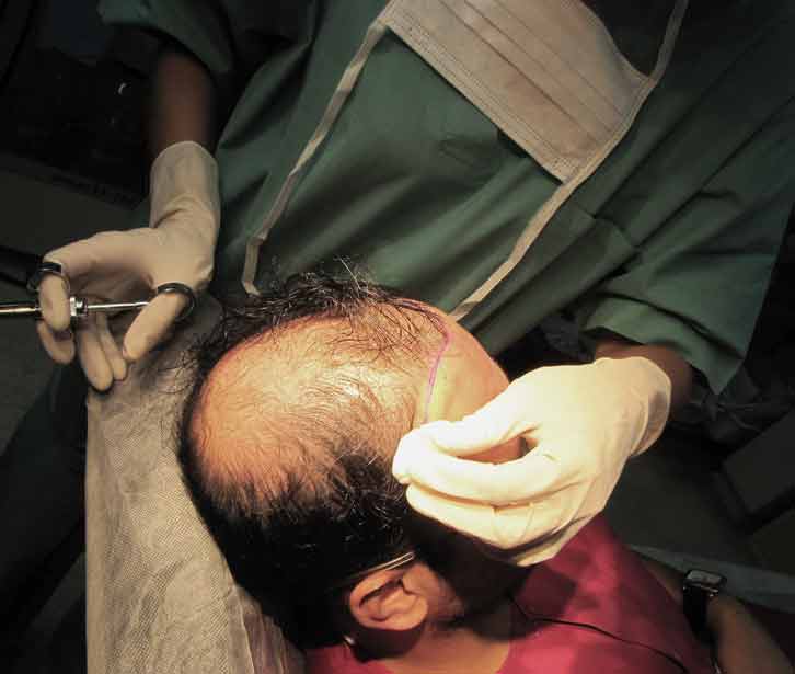 Hair Transplantation FUE Biofibre or Nido hair implantation at Exoderm  Medicals