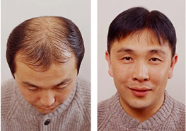 Exoderm hair implant