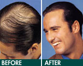  hair implant - Exoderm Medical Centers